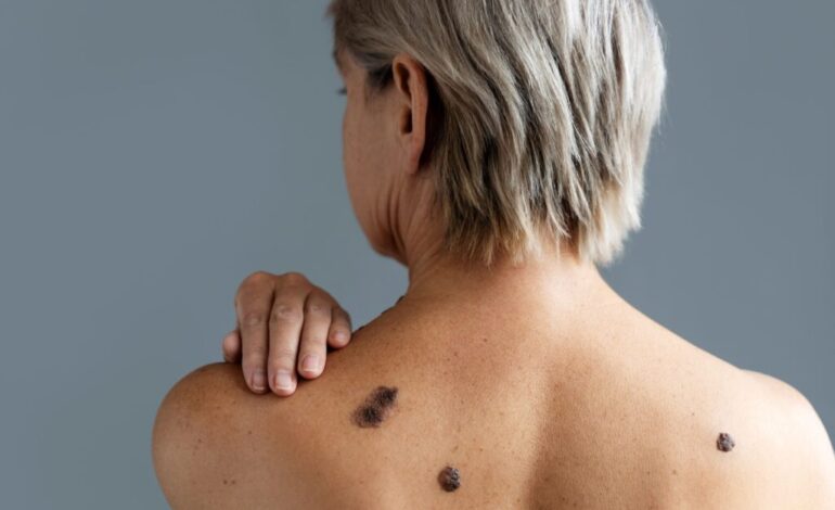 Día Mundial del Melanoma.