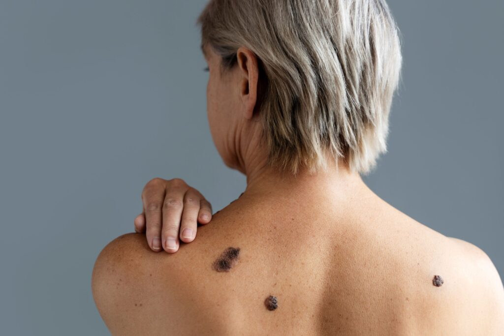 Día Mundial del Melanoma.